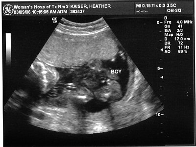 ultrasound picture